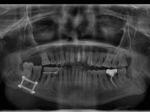 Maxillofacial trauma